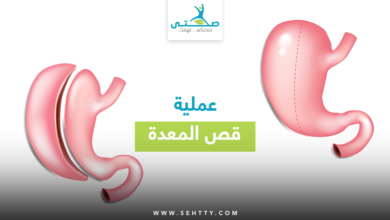 عملية قص المعدة