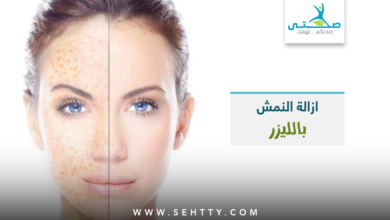 ازالة النمش بالليزر